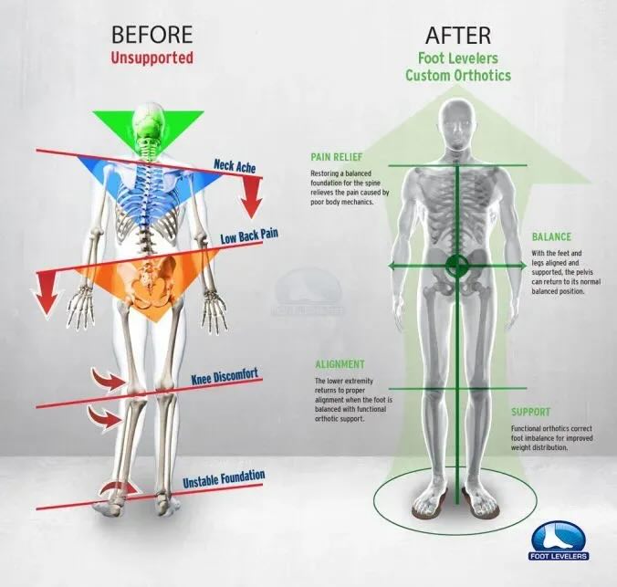 Before/after infographic showing improved alignment and balance with custom orthotics.